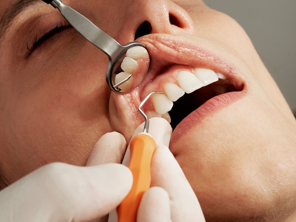 teeth cleaning